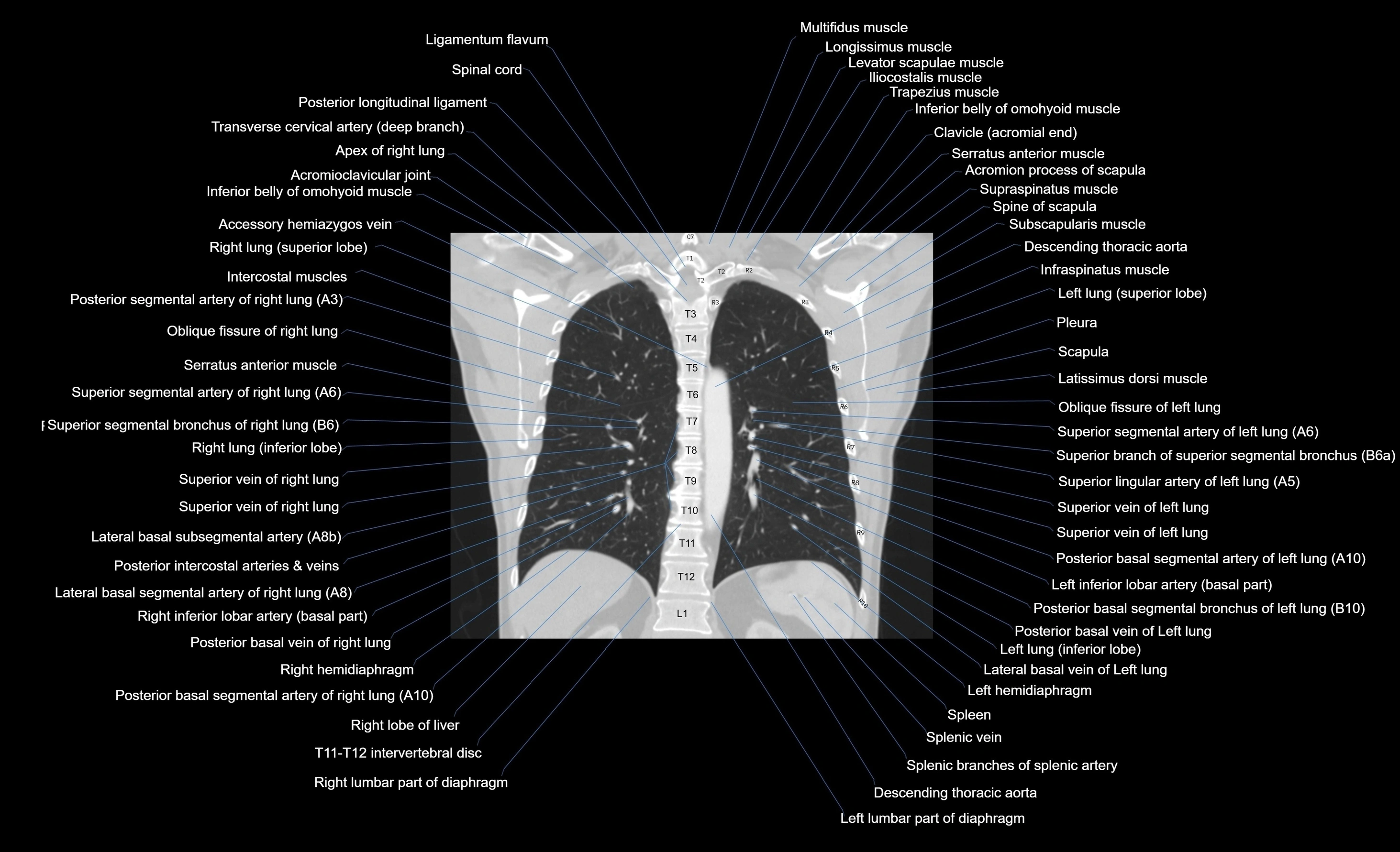 CT chest (thorax) lung window window labelled coronal cross sectional anatomy radiology image-00042.webp